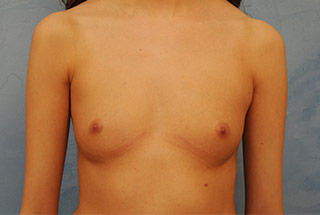 Silicone Breast Augmentation (Augmentation Mammoplasty)