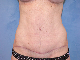 Tummy Tuck (Abdominoplasty)