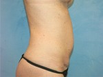 Tummy Tuck (Abdominoplasty)