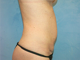 Tummy Tuck (Abdominoplasty)