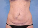 Tummy Tuck (Abdominoplasty)