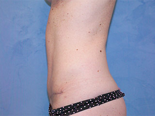 Tummy Tuck (Abdominoplasty)