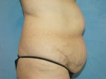 Tummy Tuck (Abdominoplasty)