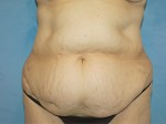 Tummy Tuck (Abdominoplasty)