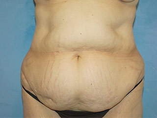 Tummy Tuck (Abdominoplasty)