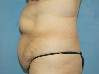 Tummy Tuck (Abdominoplasty)