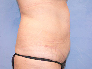 Tummy Tuck (Abdominoplasty)