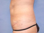 Tummy Tuck (Abdominoplasty)