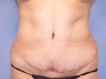 Tummy Tuck (Abdominoplasty)