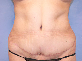 Tummy Tuck (Abdominoplasty)