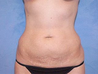 Tummy Tuck (Abdominoplasty)