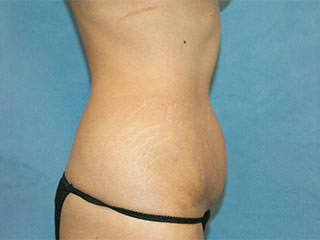 Tummy Tuck (Abdominoplasty)