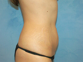 Tummy Tuck (Abdominoplasty)