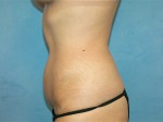 Tummy Tuck (Abdominoplasty)