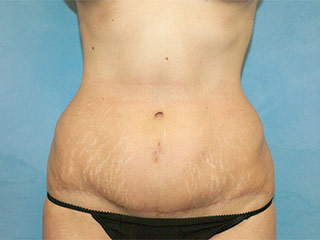 Tummy Tuck (Abdominoplasty)