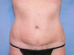 Tummy Tuck (Abdominoplasty)