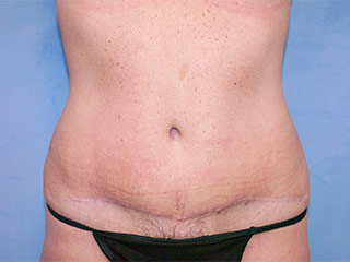 Tummy Tuck (Abdominoplasty)