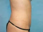 Tummy Tuck (Abdominoplasty)