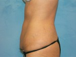 Tummy Tuck (Abdominoplasty)