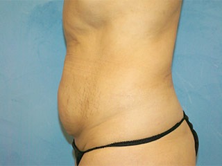 Tummy Tuck (Abdominoplasty)