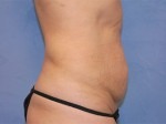 Tummy Tuck (Abdominoplasty)