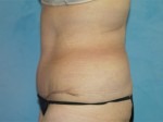 Tummy Tuck (Abdominoplasty)