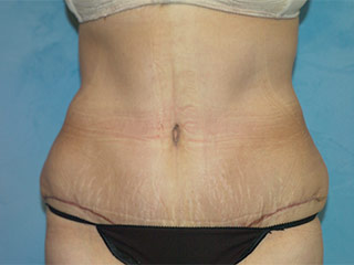 Tummy Tuck (Abdominoplasty)