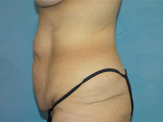 Tummy Tuck (Abdominoplasty)