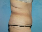 Tummy Tuck (Abdominoplasty)