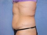 Tummy Tuck (Abdominoplasty)