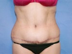 Tummy Tuck (Abdominoplasty)