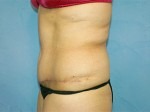 Tummy Tuck (Abdominoplasty)