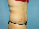 Tummy Tuck (Abdominoplasty)