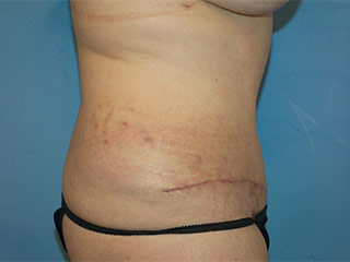 Tummy Tuck (Abdominoplasty)