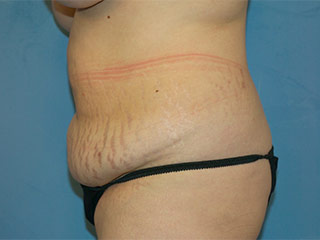 Tummy Tuck (Abdominoplasty)