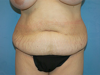 Tummy Tuck (Abdominoplasty)