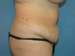 Tummy Tuck (Abdominoplasty)