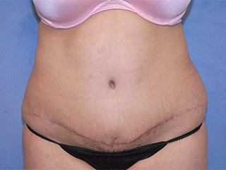 Tummy Tuck (Abdominoplasty)