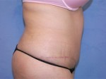 Tummy Tuck (Abdominoplasty)