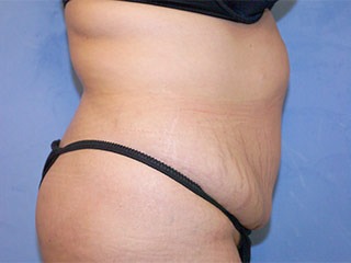 Tummy Tuck (Abdominoplasty)