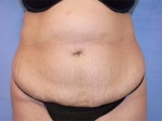 Tummy Tuck (Abdominoplasty)