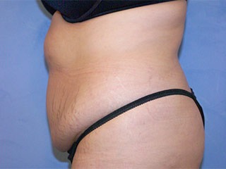 Tummy Tuck (Abdominoplasty)