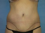 Tummy Tuck (Abdominoplasty)