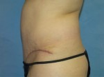 Tummy Tuck (Abdominoplasty)