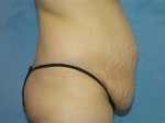 Tummy Tuck (Abdominoplasty)