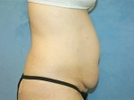 Tummy Tuck (Abdominoplasty)