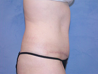 Tummy Tuck (Abdominoplasty)