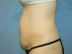 Tummy Tuck (Abdominoplasty)