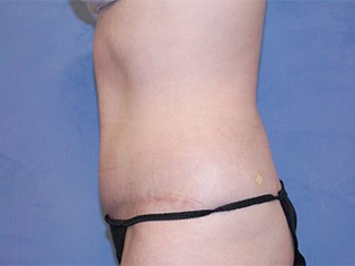 Tummy Tuck (Abdominoplasty)