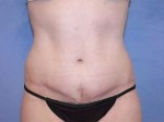 Tummy Tuck (Abdominoplasty)